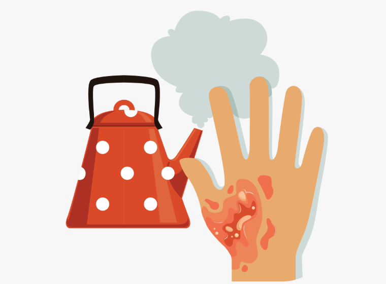 First Aid: Burns - Quick Course